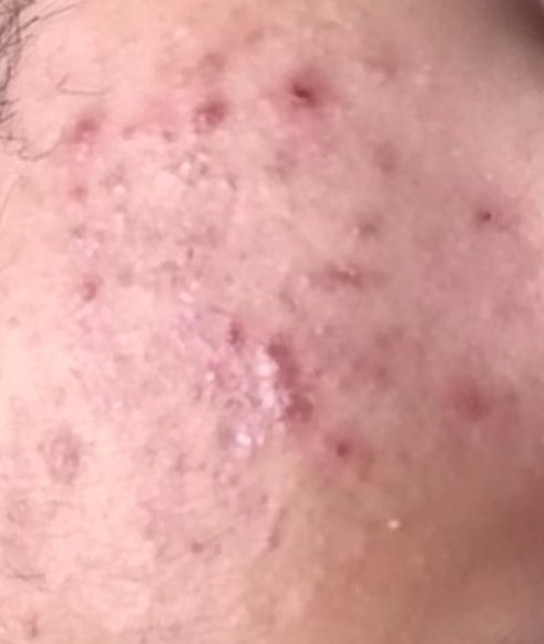 PEELING FACIAL I'VEL